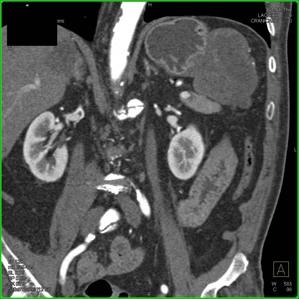 Gastric GIST Tumor - Stomach Case Studies - CTisus CT Scanning