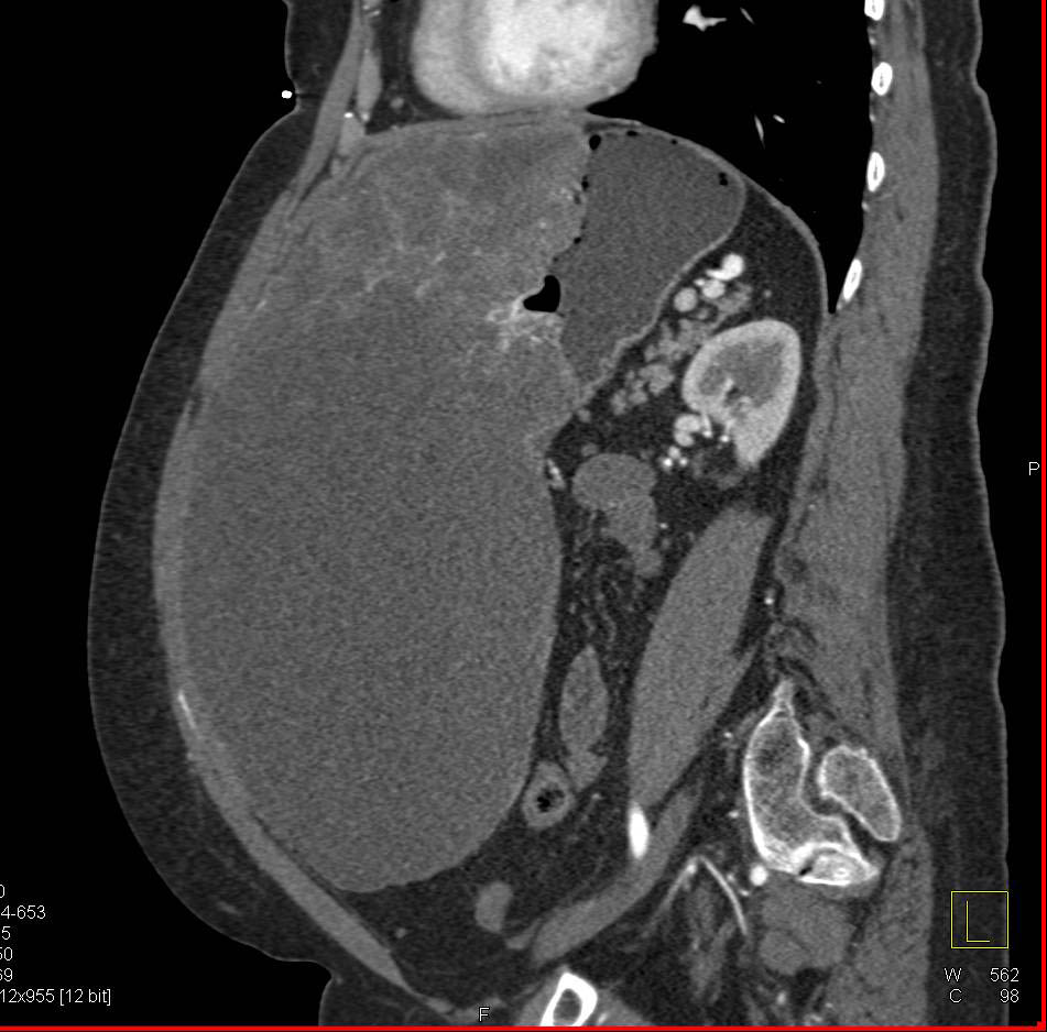 Classic Large Gastric GIST Tumor with Neovascularity - CTisus CT Scan