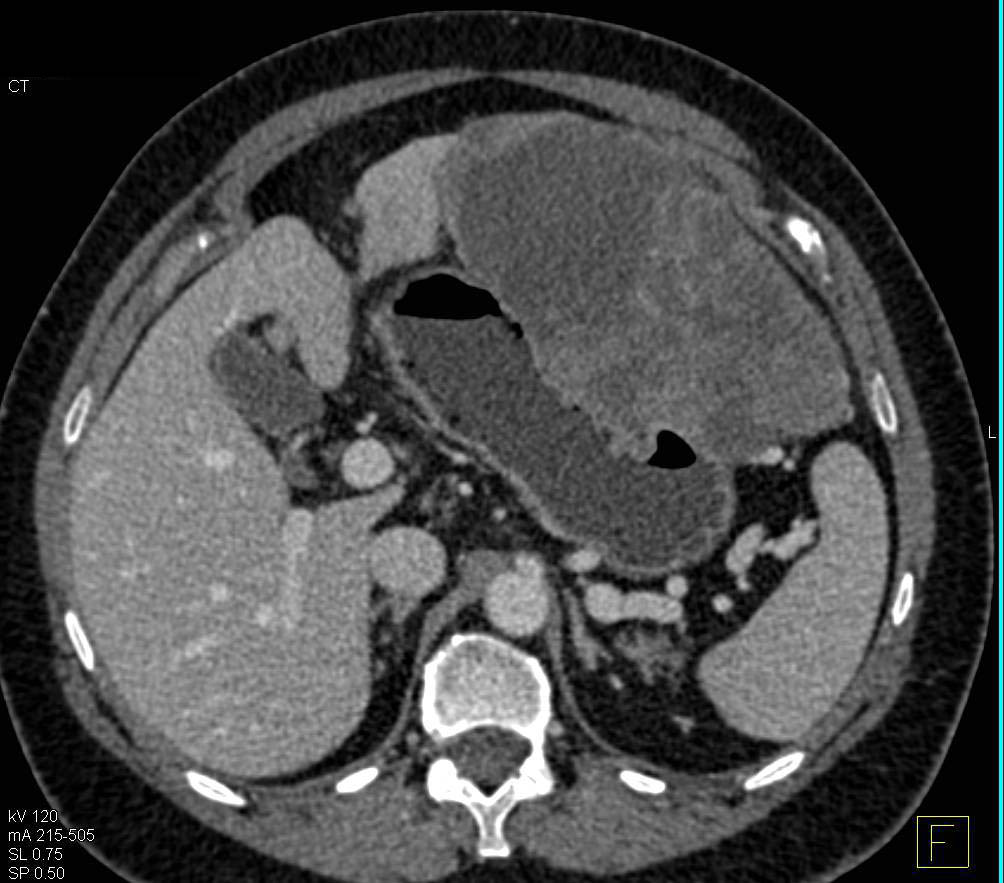 Large Exophytic Gastric GIST Tumor - CTisus CT Scan