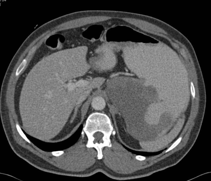 Ulcerating Gastric GIST Tumor - CTisus CT Scan
