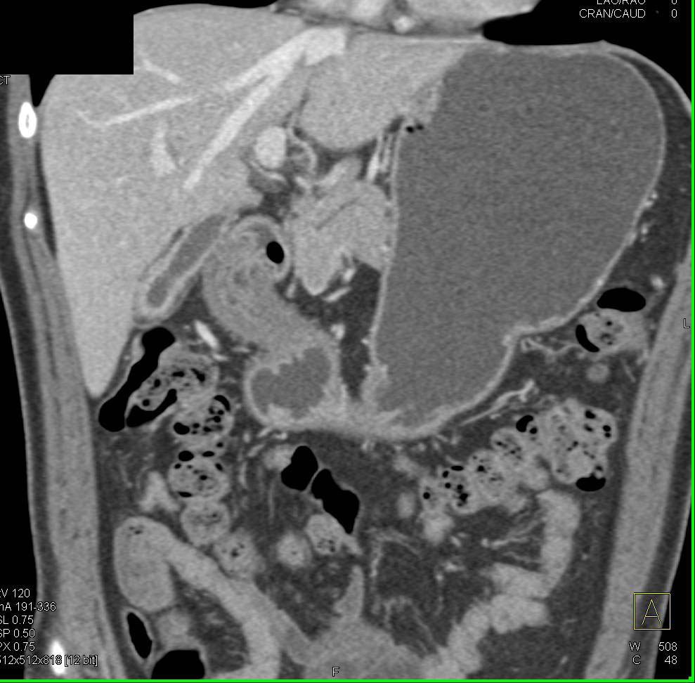 Pseudotumor in Gastric Antrum - CTisus CT Scan