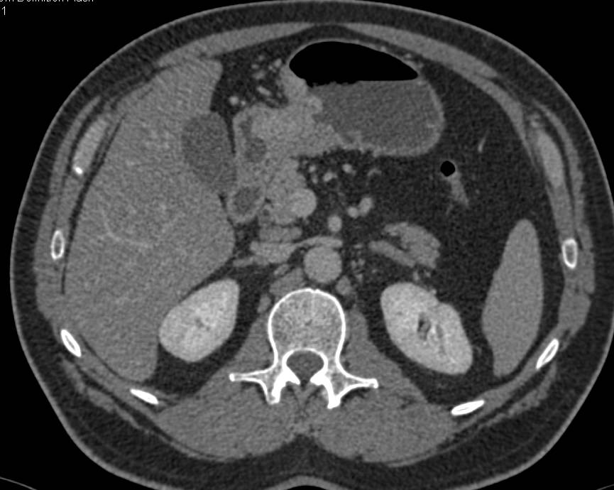 Carcinoma of the Gastric Antrum - CTisus CT Scan