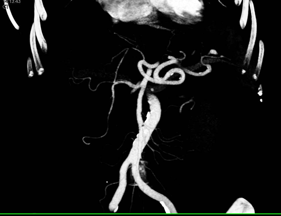 Large Hiatal Hernia - CTisus CT Scan