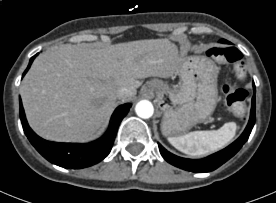 Undistended Stomach Leads to Many False Positive and False Negative studies - CTisus CT Scan