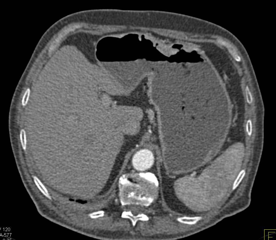 Ulcerating Gastric Cancer - CTisus CT Scan