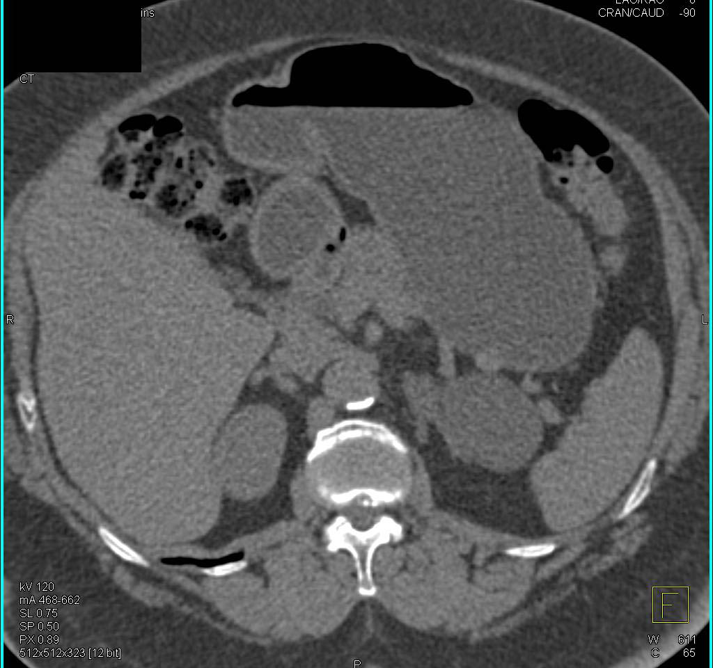 Gastric Diverticulum - CTisus CT Scan