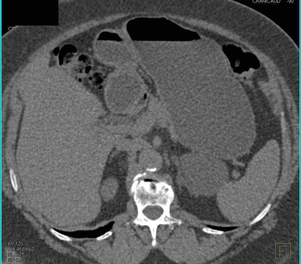 Gastric Diverticulum Simulates an Adrenal Mass - CTisus CT Scan