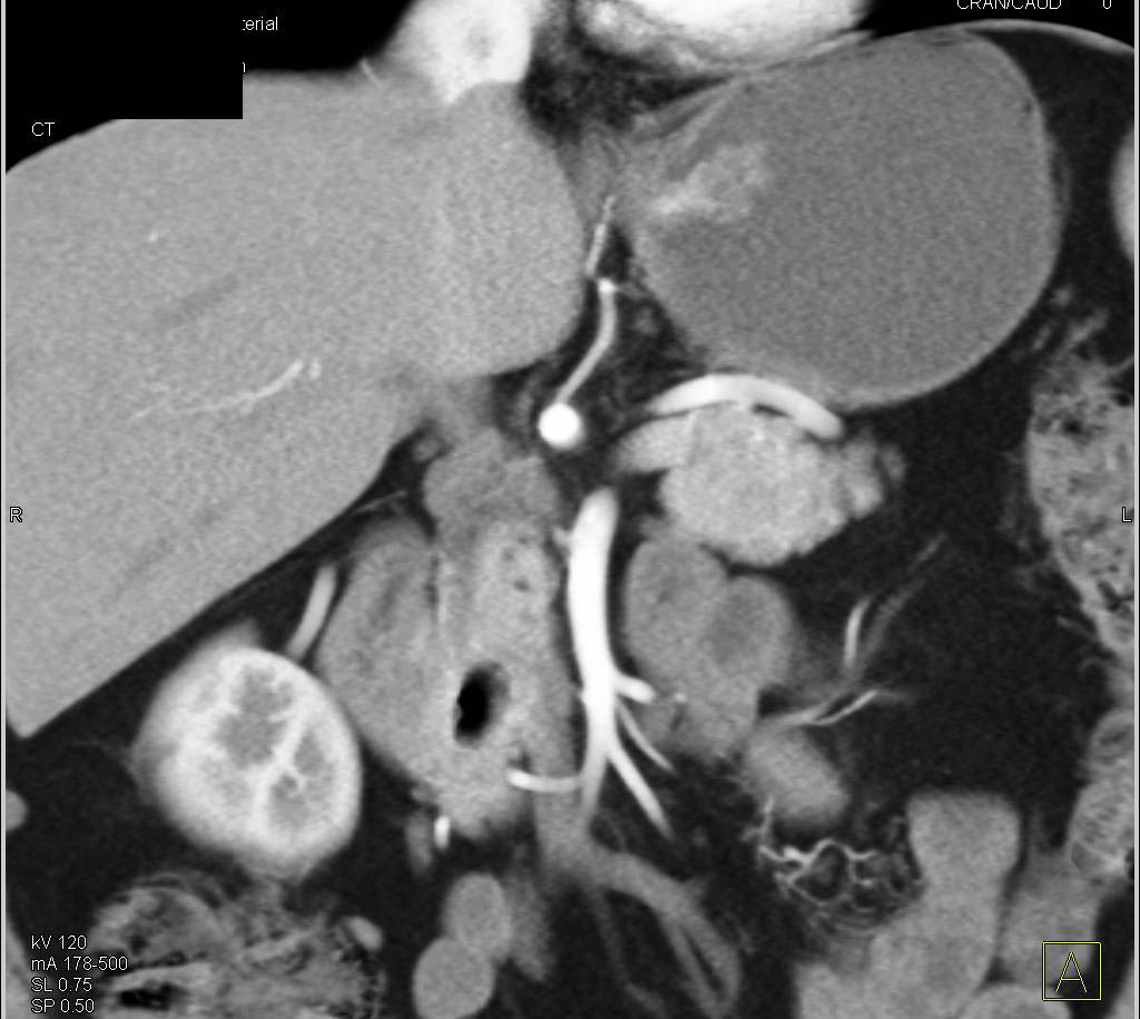 Subtle Gastric Cancer - CTisus CT Scan