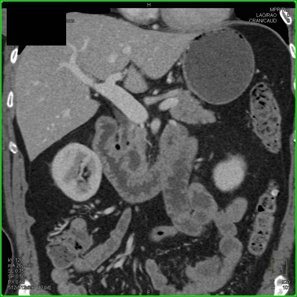 Gastric Cancer in the Fundus of the Stomach - CTisus CT Scan