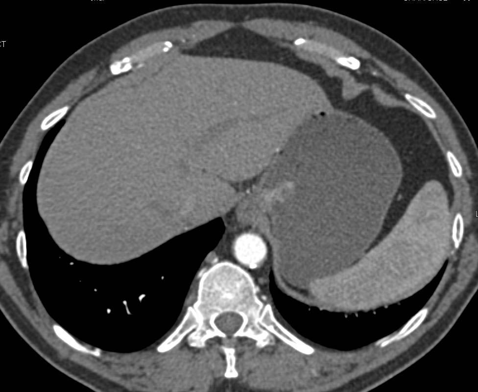 Carcinoma at Gastroesophageal (GE) Junction - CTisus CT Scan