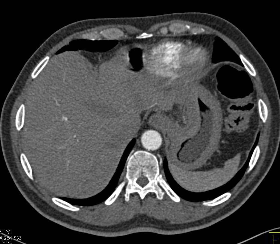 Linitis Plastica of the Stomach with Liver Metastases - CTisus CT Scan