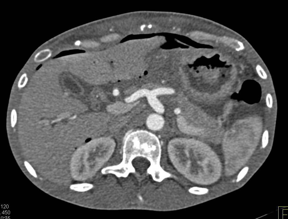 Stent Placed in Stomach in Patient with Gastric Cancer and Carcinomatosis - CTisus CT Scan