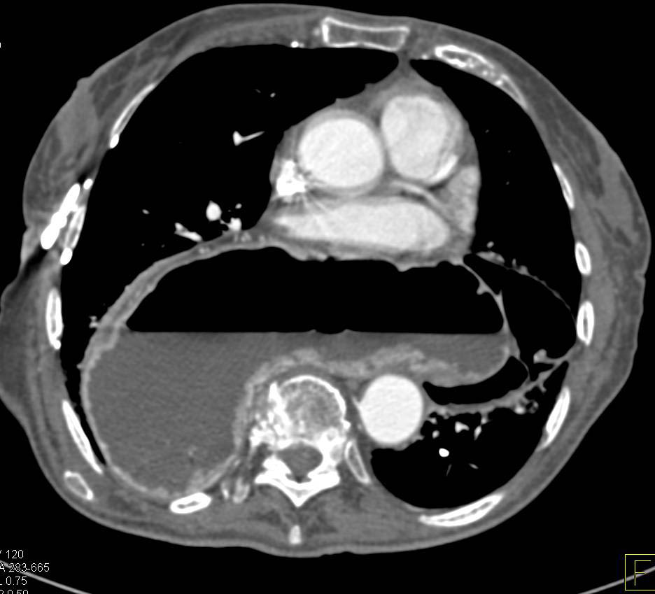 Gastric Volvulus is Developing - CTisus CT Scan