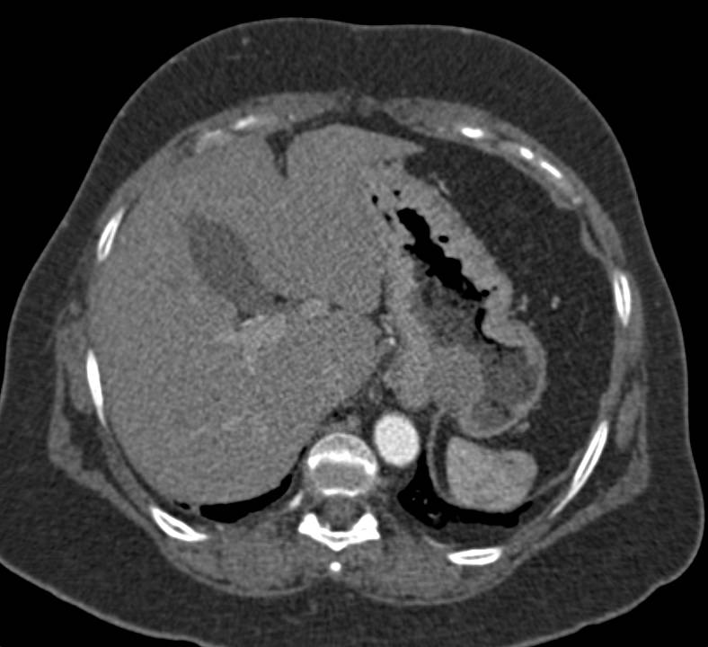 Gastritis with Thickened Folds - CTisus CT Scan