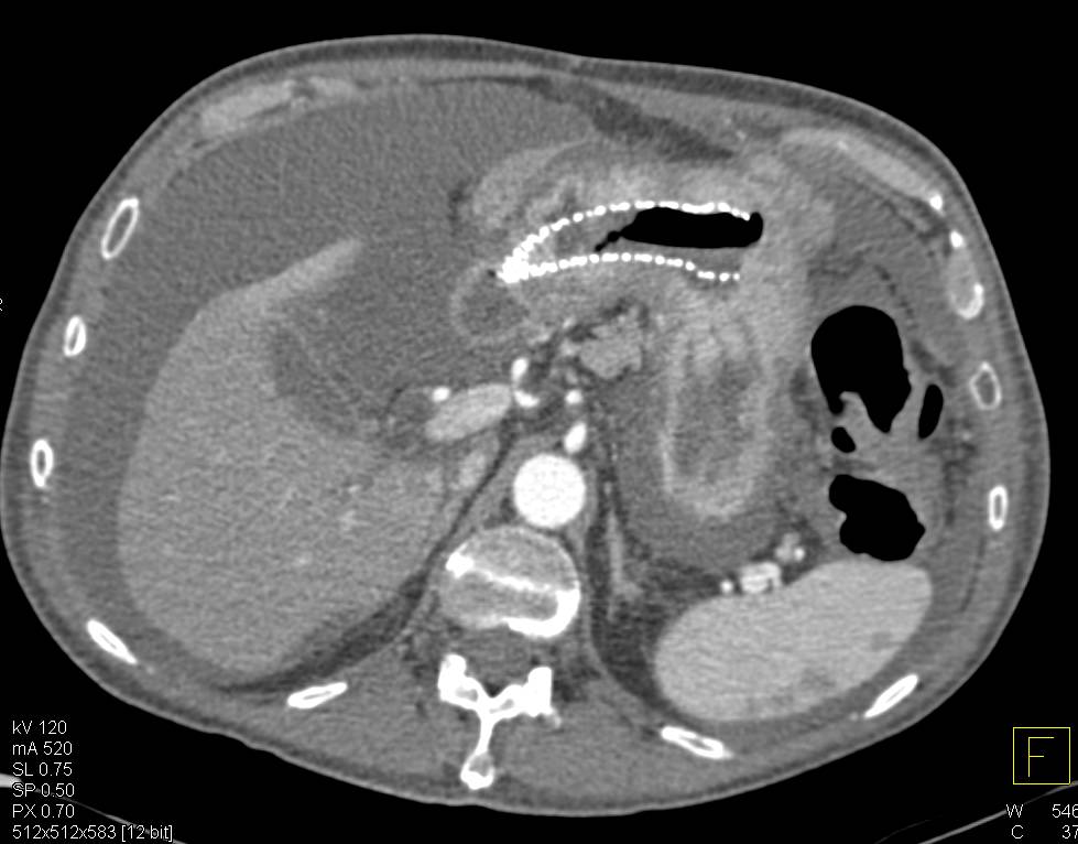 Gastric Adenocarcinoma with Stent in Place - CTisus CT Scan