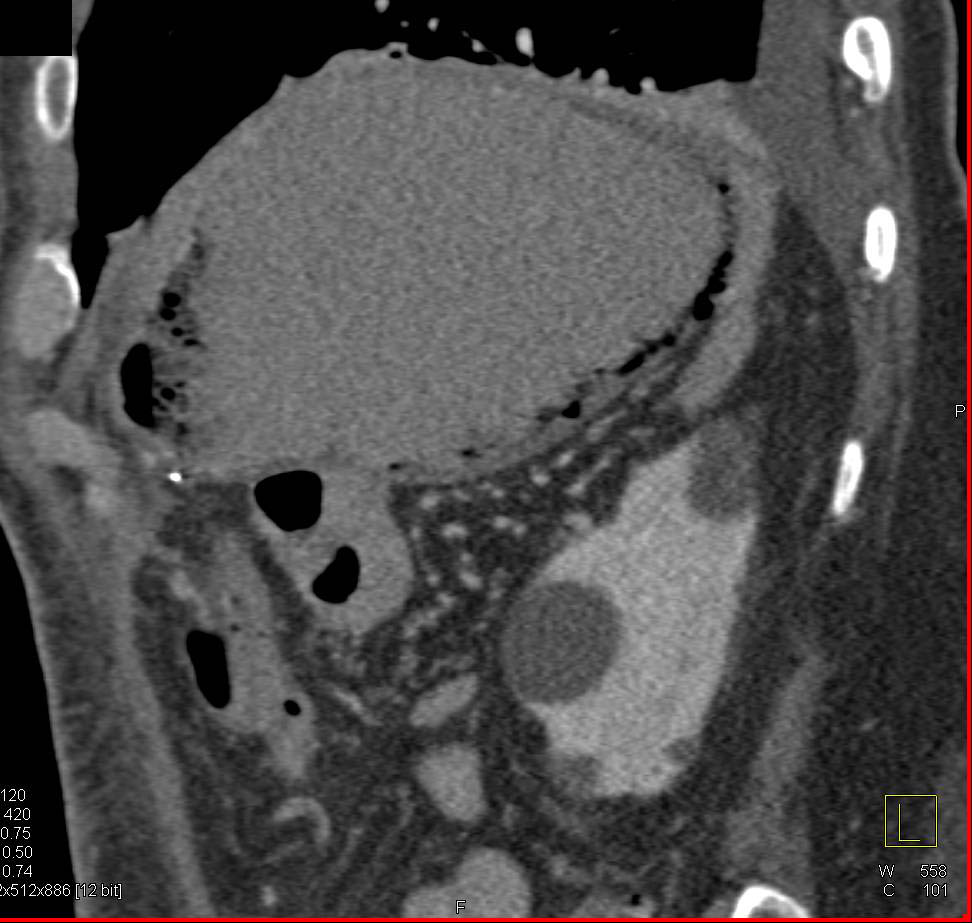 Gastric Emphysema - CTisus CT Scan