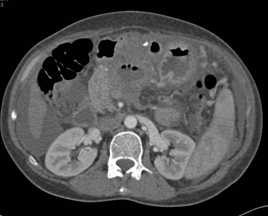 Gastric Cancer with Carcinomatosis - CTisus CT Scan