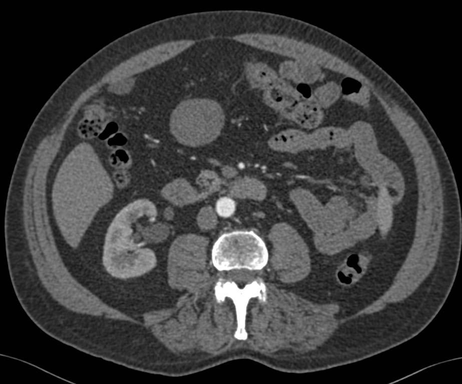 Gastric GIST Tumor (Exophytic) - CTisus CT Scan