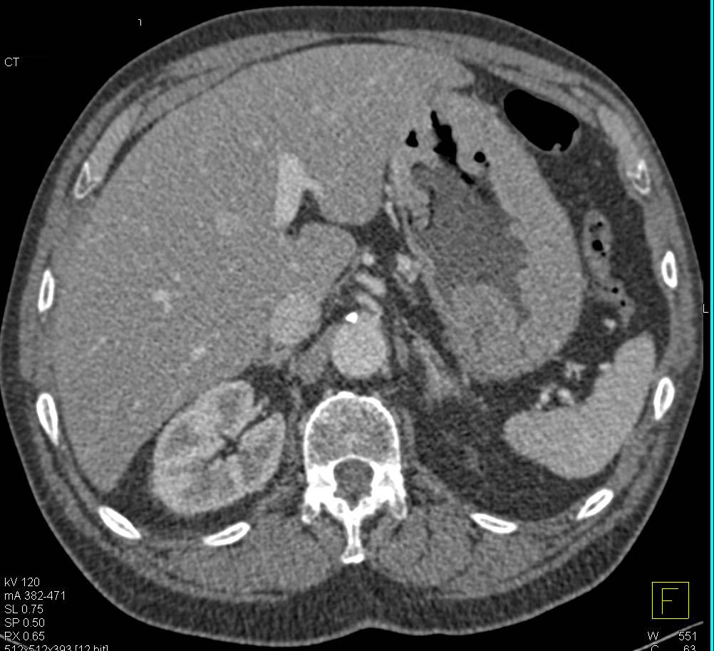 Thickened Gastric Folds in Zollinger-Ellison Syndrome - CTisus CT Scan