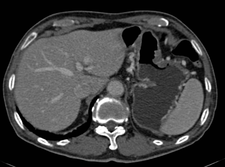 Infiltrating Gastric Adenocarcinoma - CTisus CT Scan