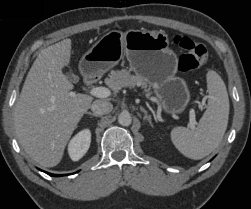 Inflammatory Gastric Polyps - CTisus CT Scan