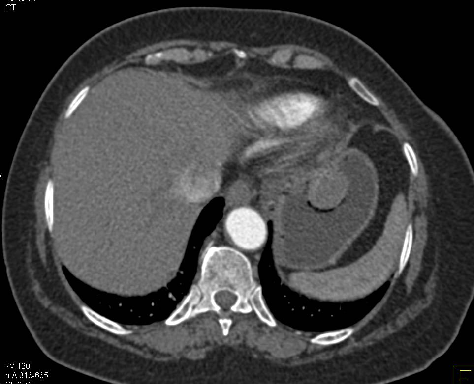 Intraluminal Gastric GIST Tumor - CTisus CT Scan