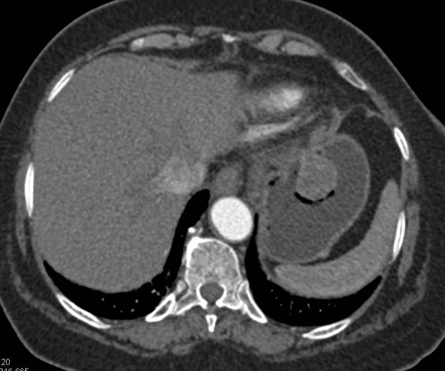 Gastric GIST Tumor - CTisus CT Scan