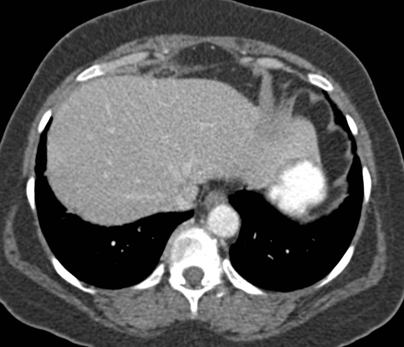 Gastric Cancer with Perforation and Omental Stranding - CTisus CT Scan