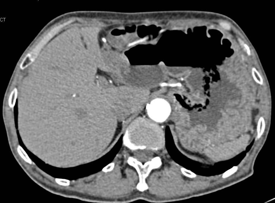 Gastric Adenocarcinoma with Ulceratiions - CTisus CT Scan