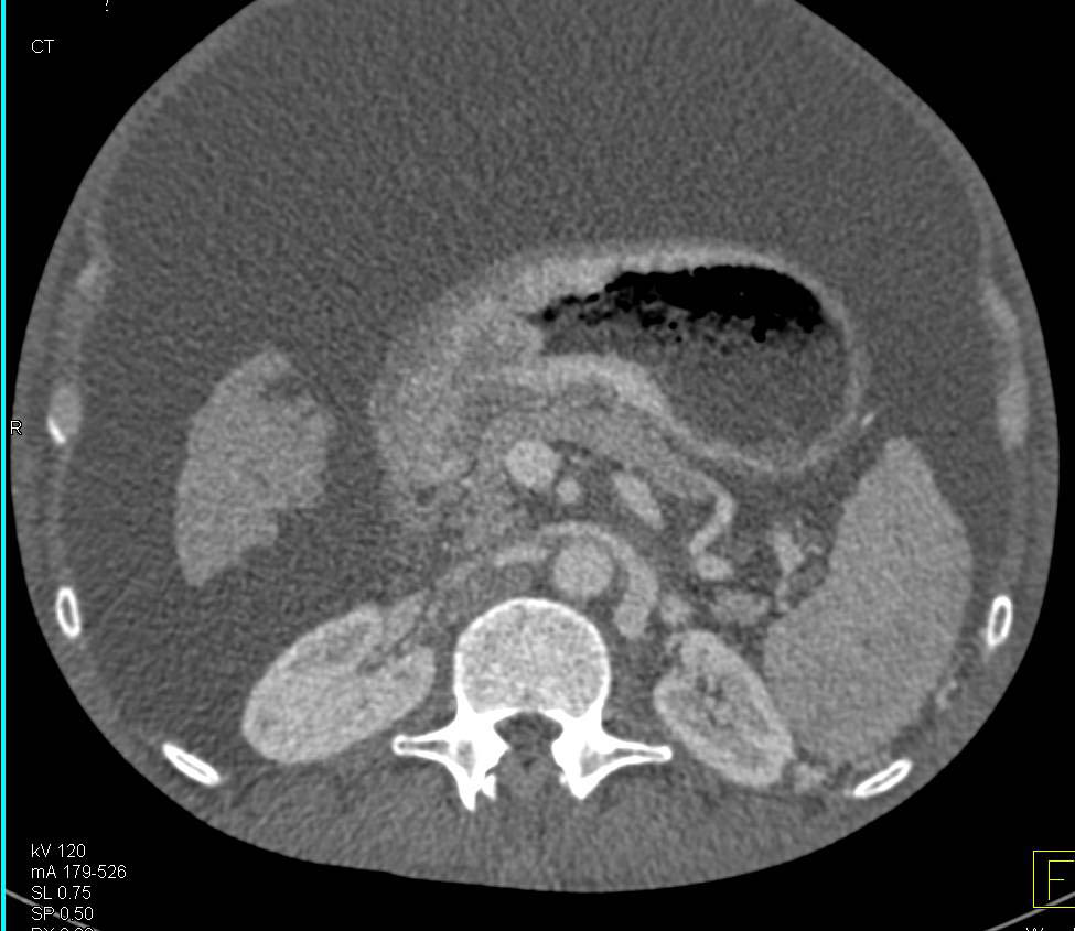 Gastric Cancer Presents as Linitis Plastica with Ascites - CTisus CT Scan