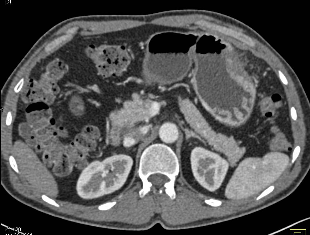 Gastric Carcinoma Body of Stomach with Perforation - CTisus CT Scan