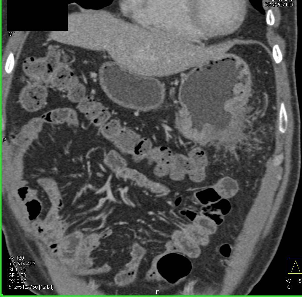 Perforated Ulcer in Gastric Cancer with Fistulae to Small Bowel - CTisus CT Scan