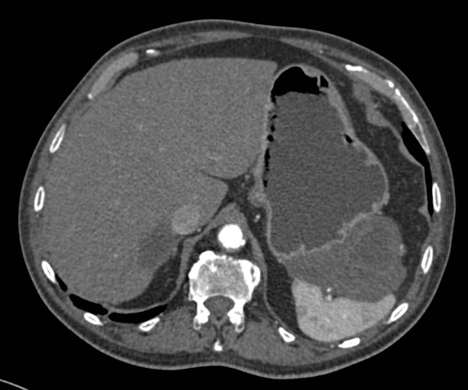 Gastric GIST Tumor - CTisus CT Scan