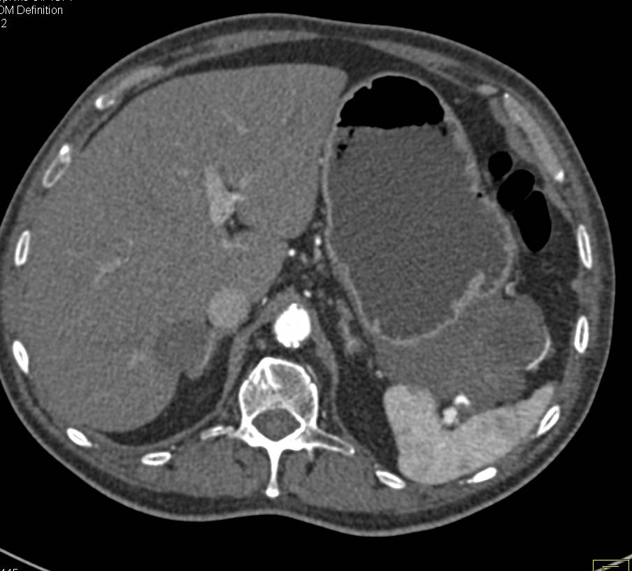 Gastric GIST Tumor - CTisus CT Scan