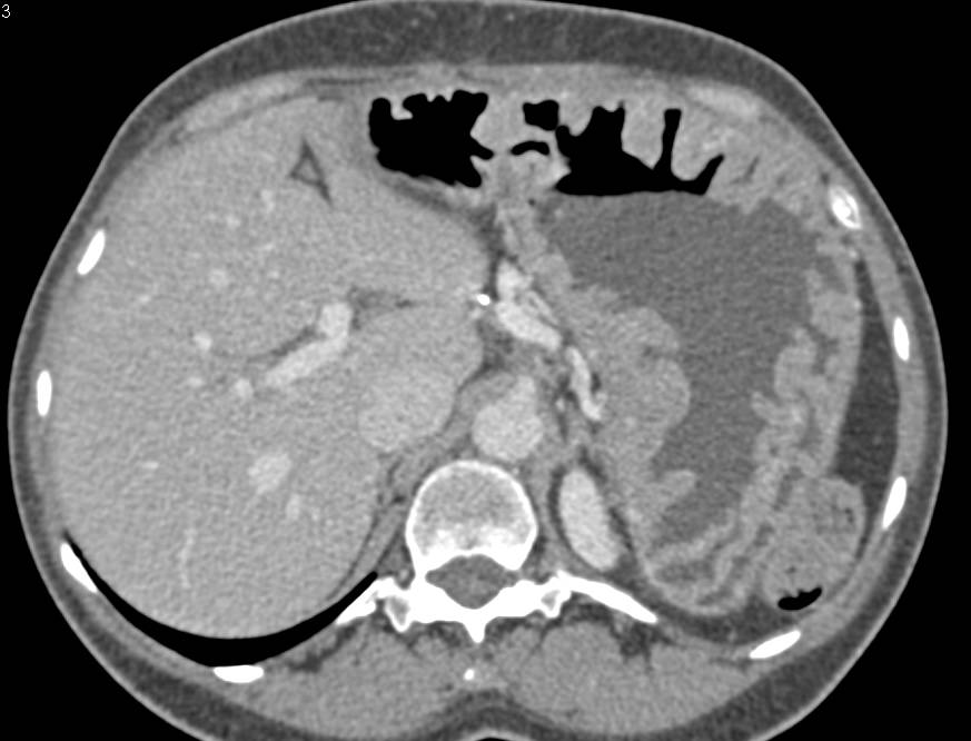 Zollinger-Ellison Syndrome with Thick Gastric Folds - CTisus CT Scan