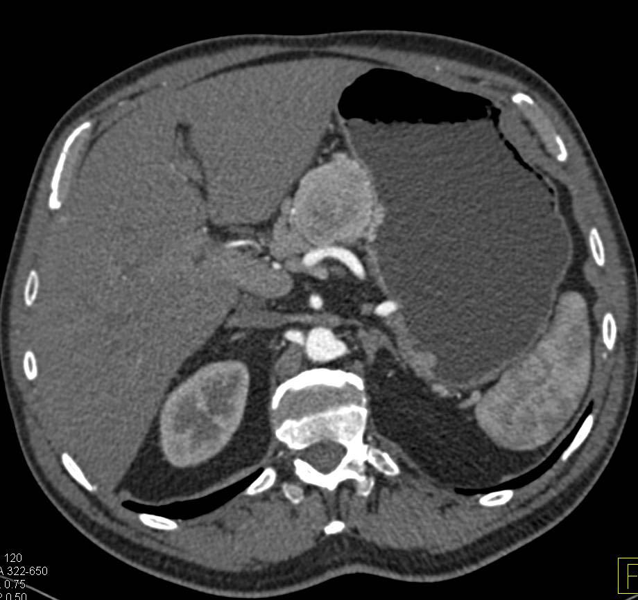 Gastric Carcinoid Tumor with Enhancing Celiac Adenopathy - CTisus CT Scan