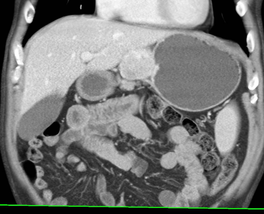 Gastric Carcinoid Tumor with Enhancing Celiac Adenopathy - CTisus CT Scan