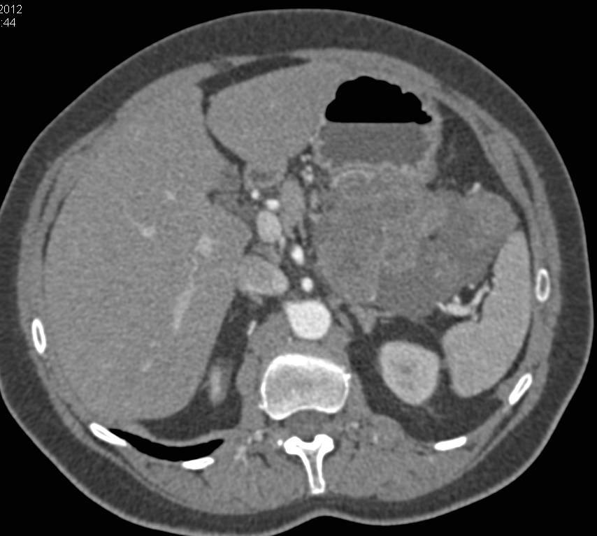 Gastric GIST Tumor (Exophytic) - CTisus CT Scan