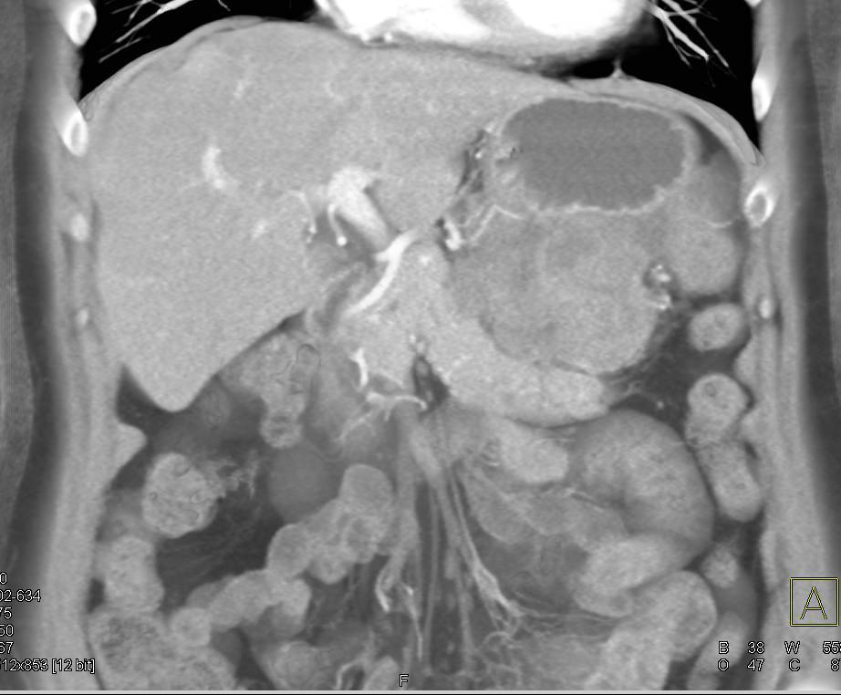 Gastric GIST Tumor (Exophytic) Stomach Case Studies