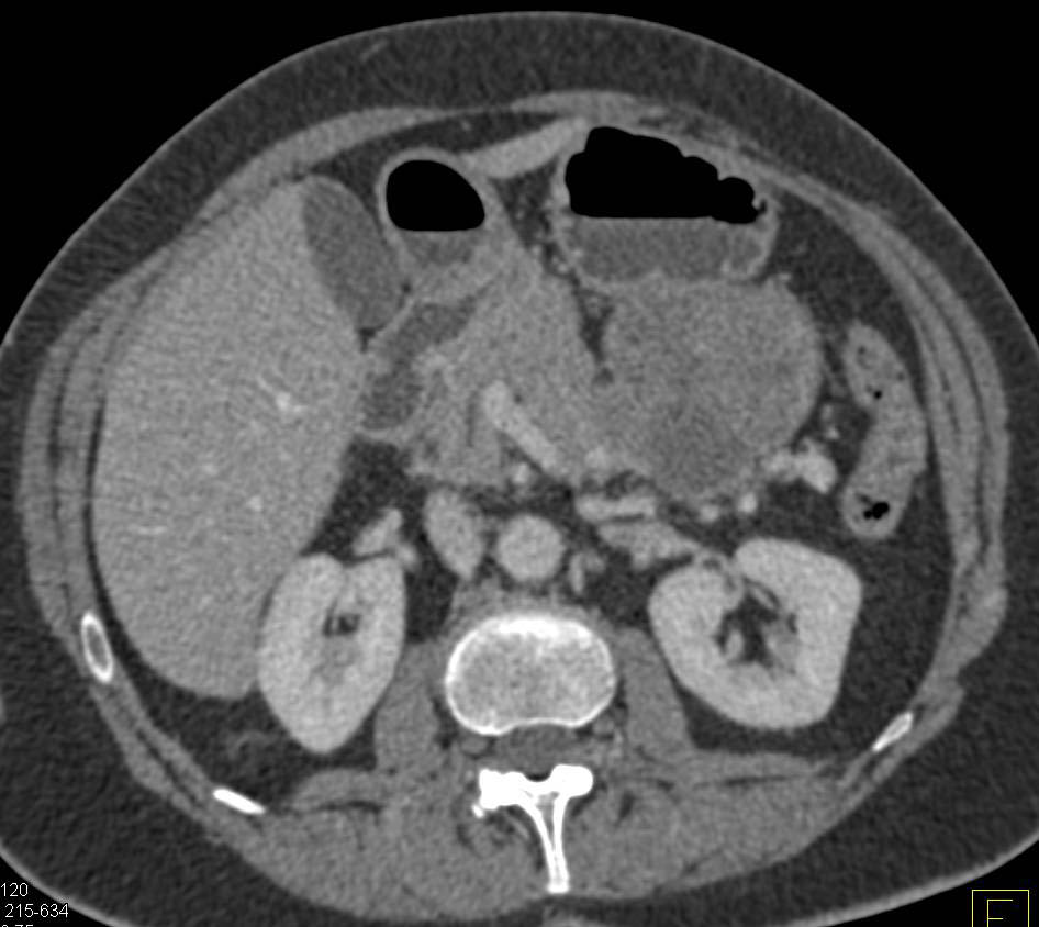 Exophytic Gastric GIST Tumor - CTisus CT Scan