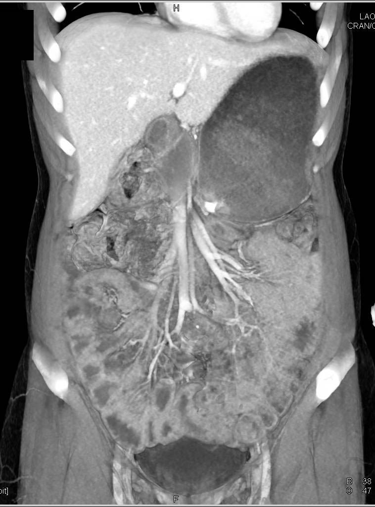 Delayed Gastric Emptying on CT - Stomach Case Studies - CTisus CT Scanning