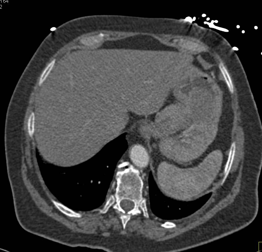 Bulky Gastric Adenocarcinoma in the Fundus - CTisus CT Scan