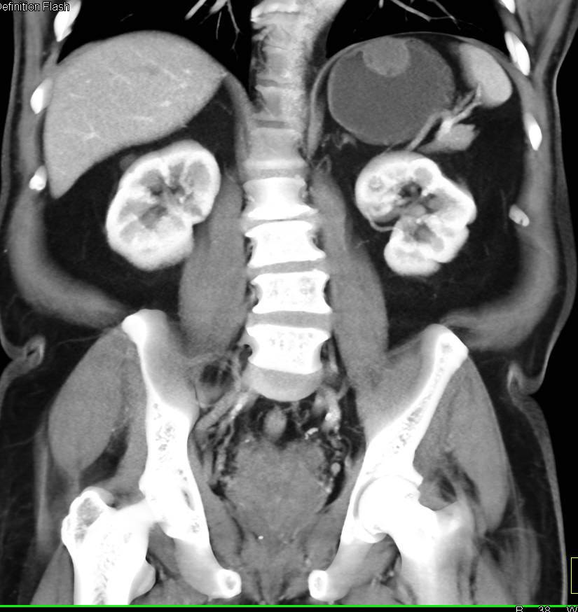 Gastric GIST Tumor - CTisus CT Scan