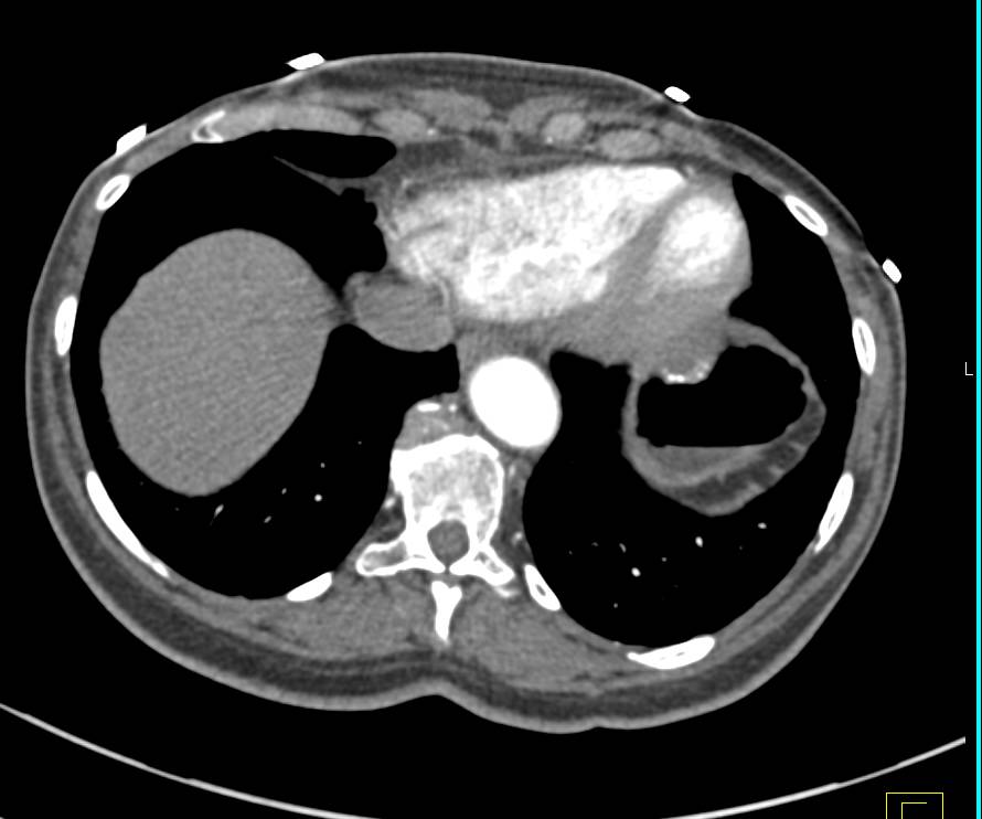 Partially Calcified GIST Tumor in the Stomach - CTisus CT Scan