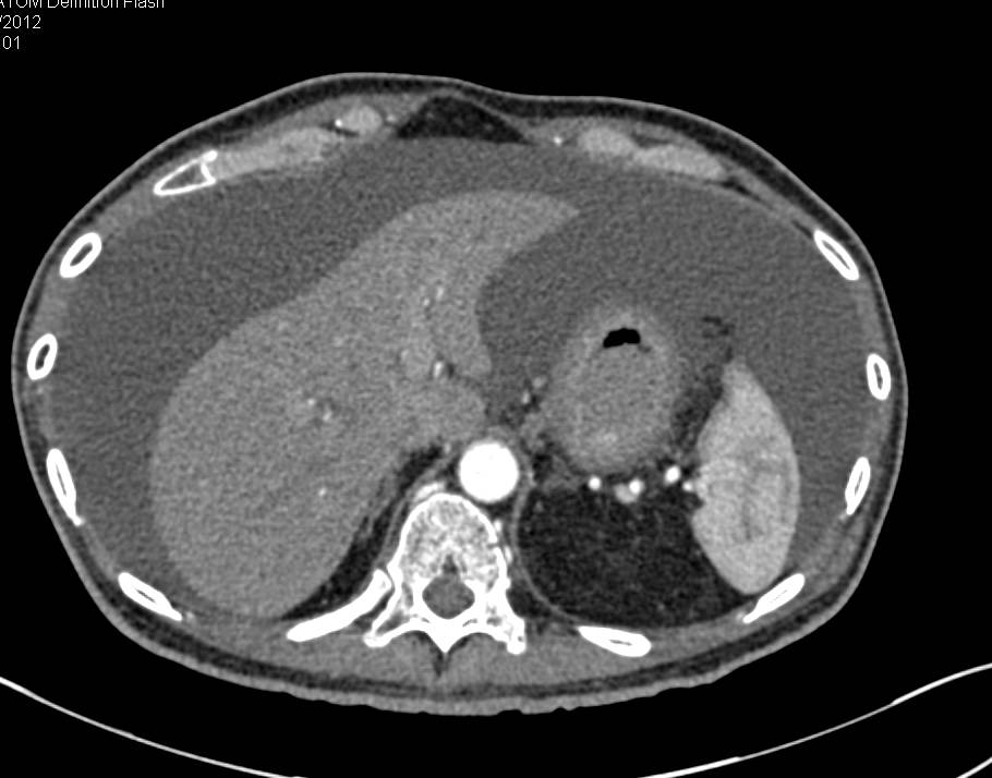 Linitis Plastica Stomach with Ascites Secondary to Breast Cancer Metastases - CTisus CT Scan