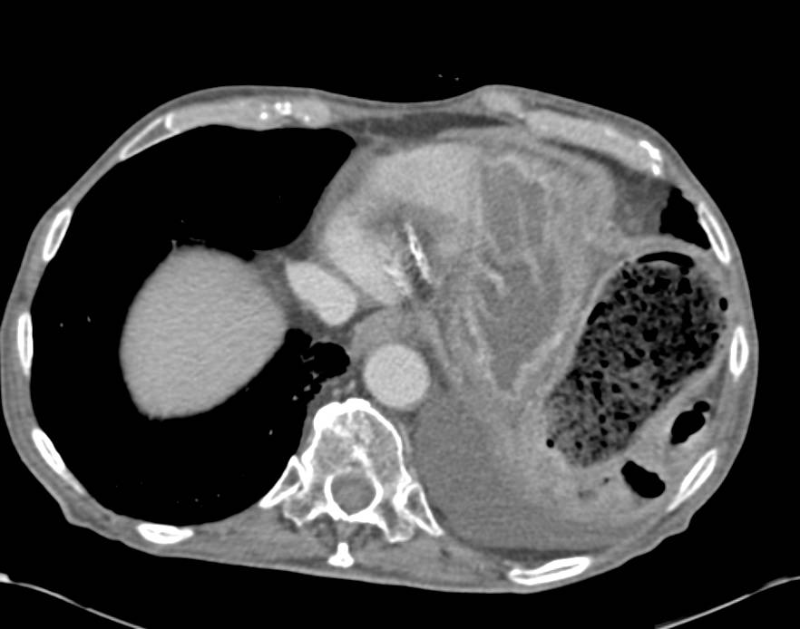 Gastrojejunal Bypass with Stent in Patient with Carcinomatosis - CTisus CT Scan