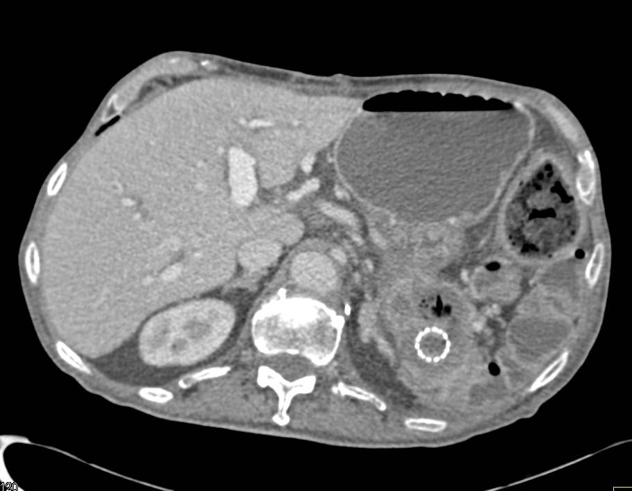 Gastrojejunal Bypass with Stent in Patient with Carcinomatosis - CTisus CT Scan