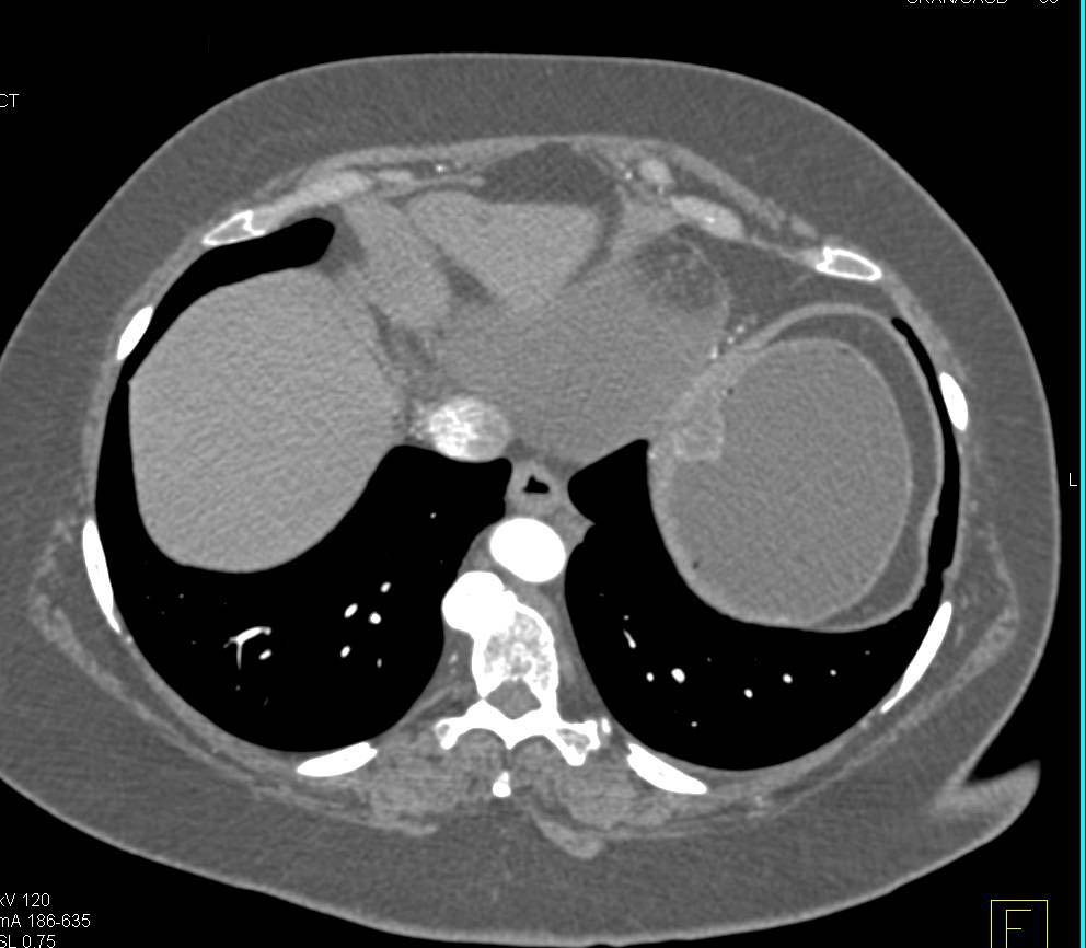 Gastric GIST Tumor in the Fundus - CTisus CT Scan