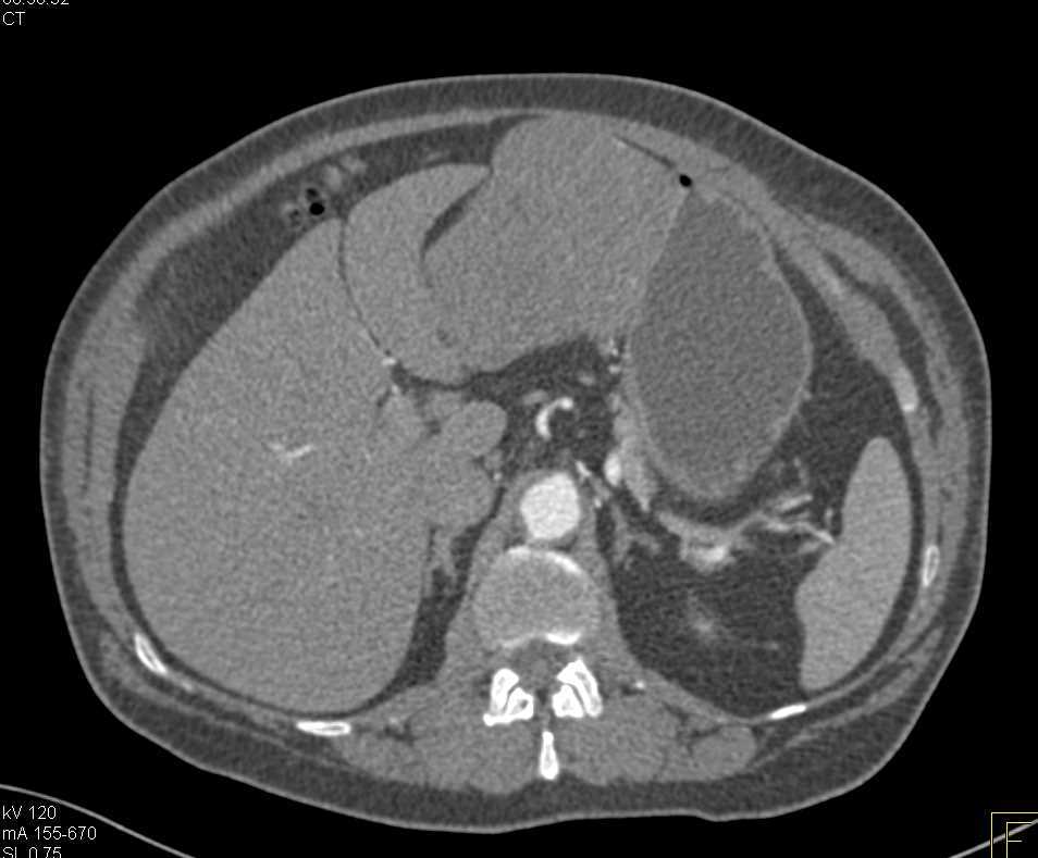 Gastric GIST Tumor - CTisus CT Scan