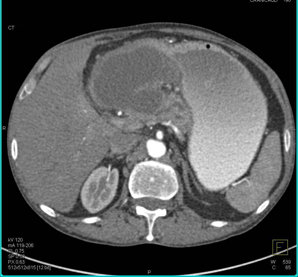 Gastric GIST Tumor - CTisus CT Scan